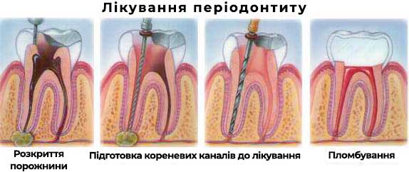 Процес лікування періодонтиту